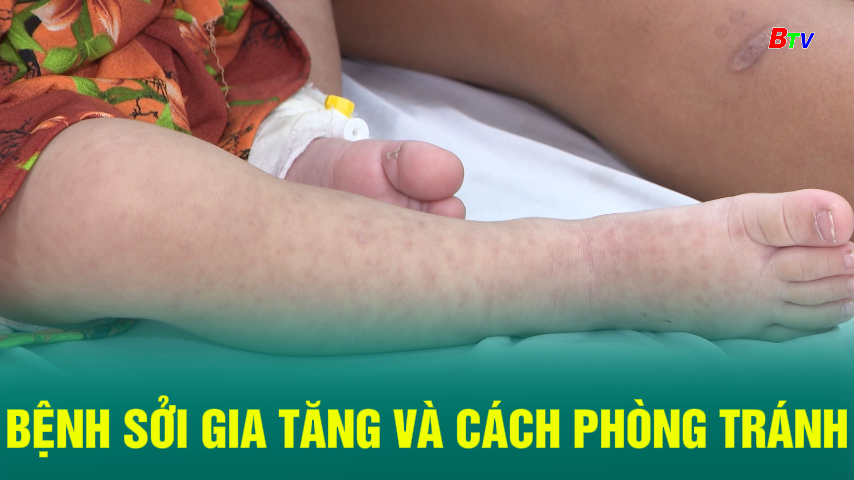 Bệnh sởi gia tăng và cách phòng tránh