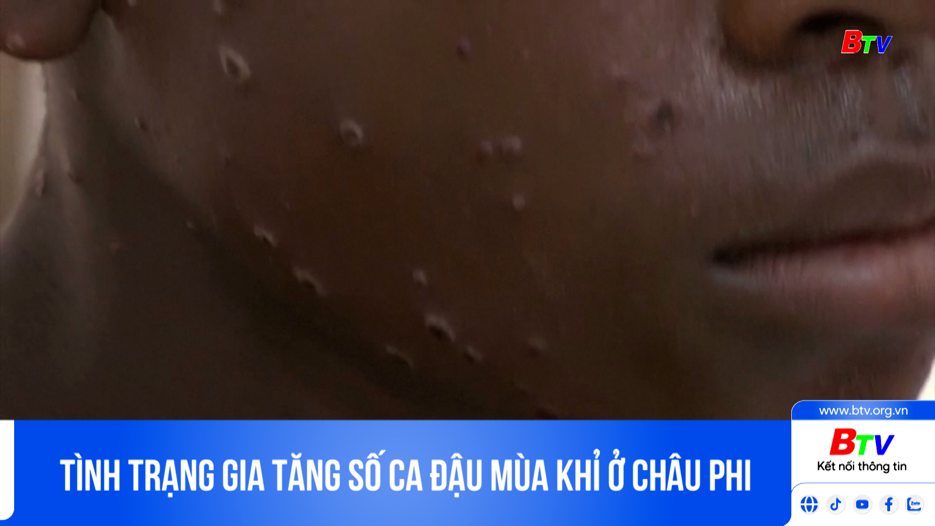 	Tình trạng gia tăng số ca đậu mùa khỉ ở châu Phi