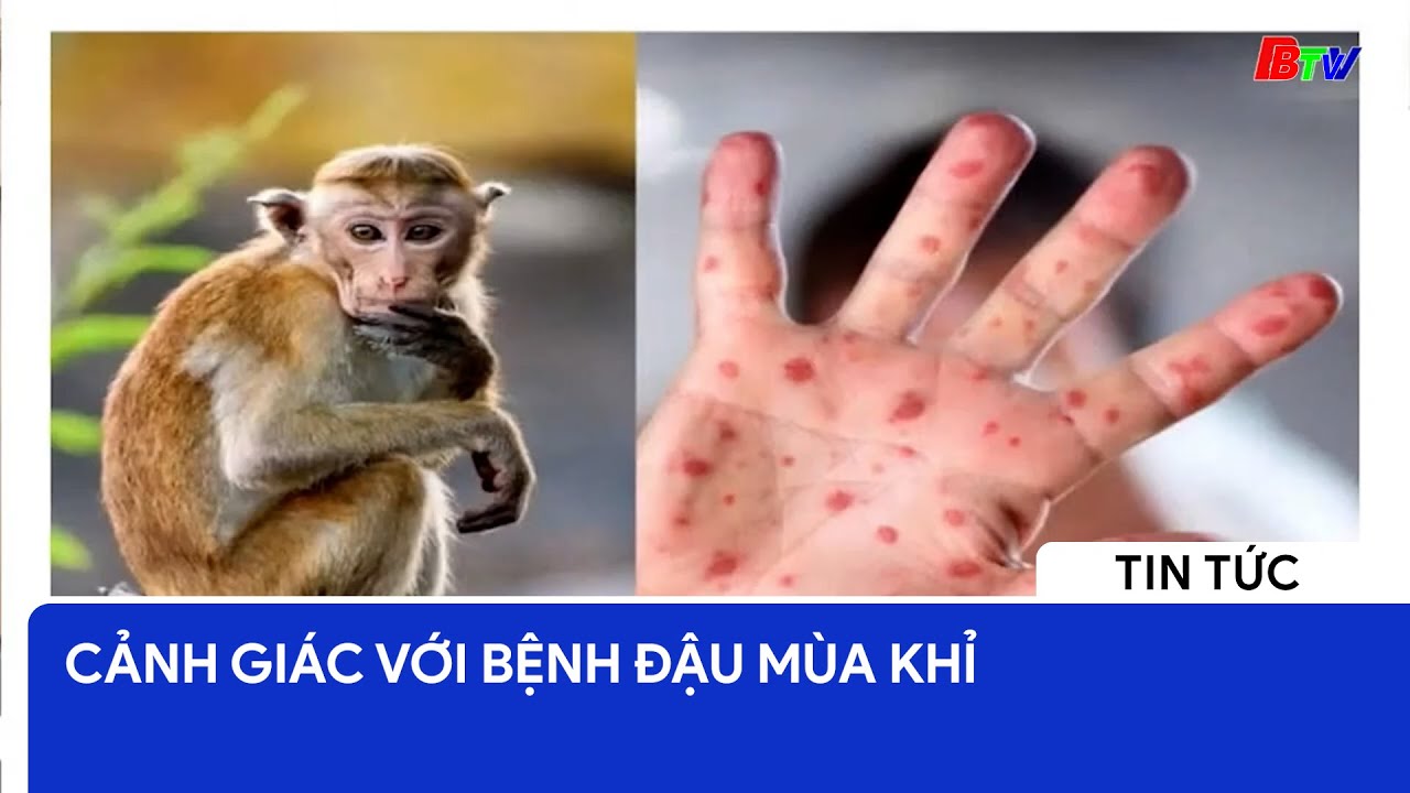 Cảnh giác với bệnh đậu mùa khỉ