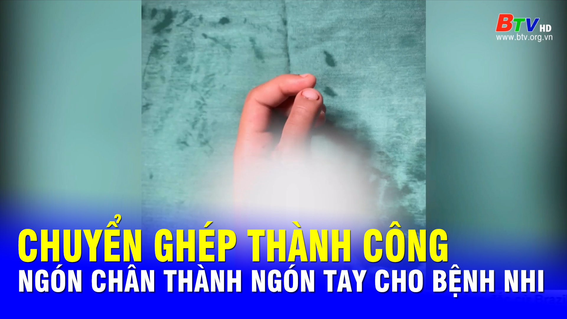 Chuyển ghép thành công ngón chân thành ngón tay cho bệnh nhi