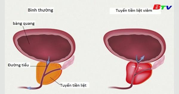 Tăng sinh lành tính tuyến tiền liệt