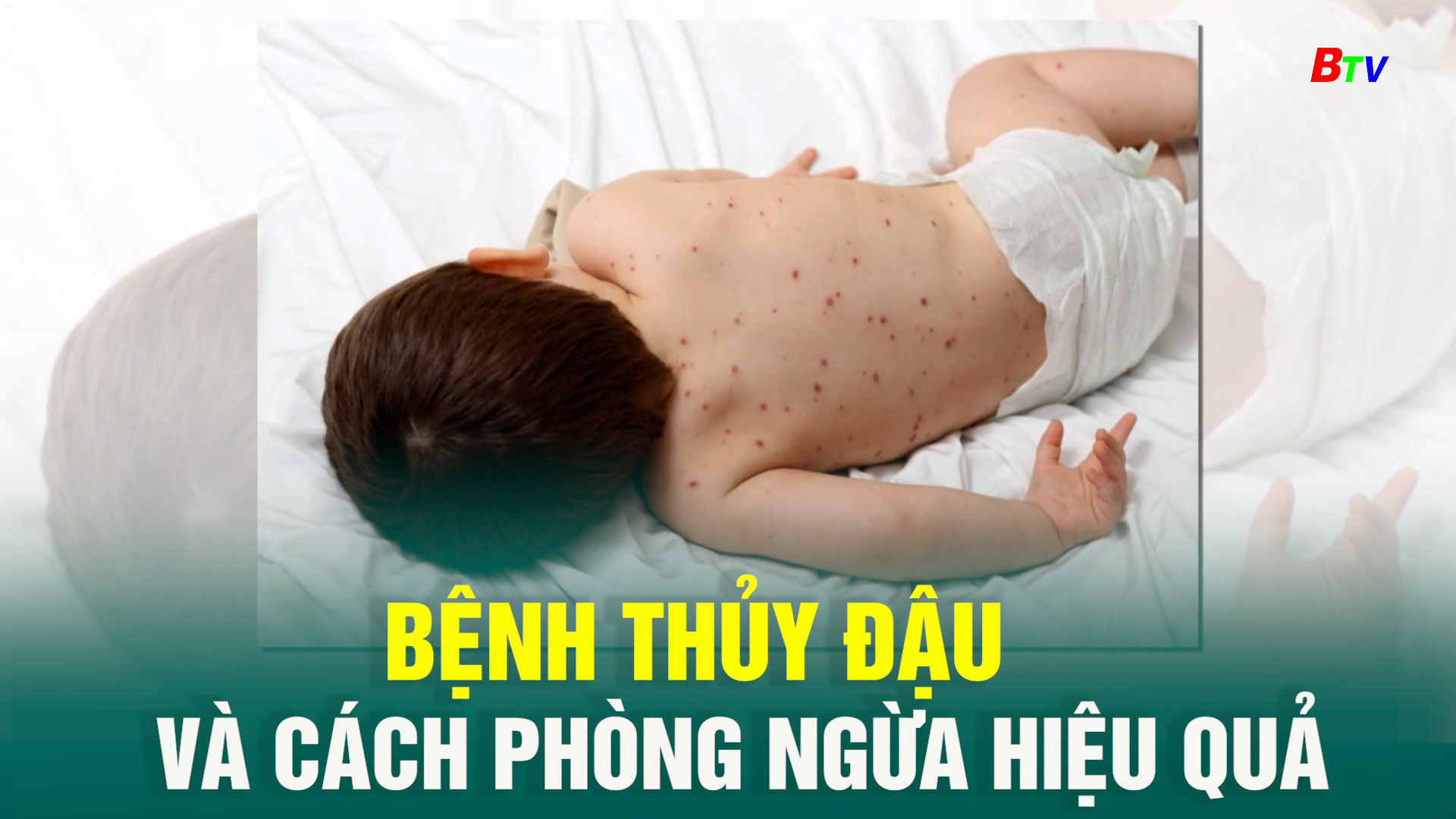 Bệnh Thủy đậu và cách phòng ngừa hiệu quả