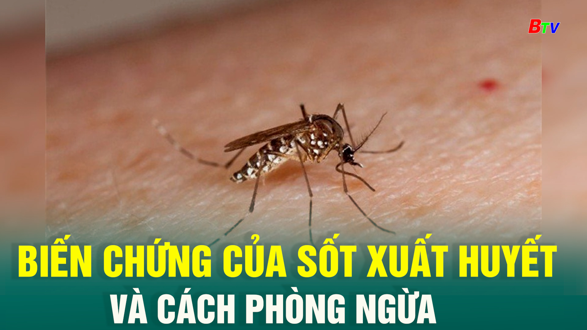 Biến chứng của sốt xuất huyết và cách phòng ngừa