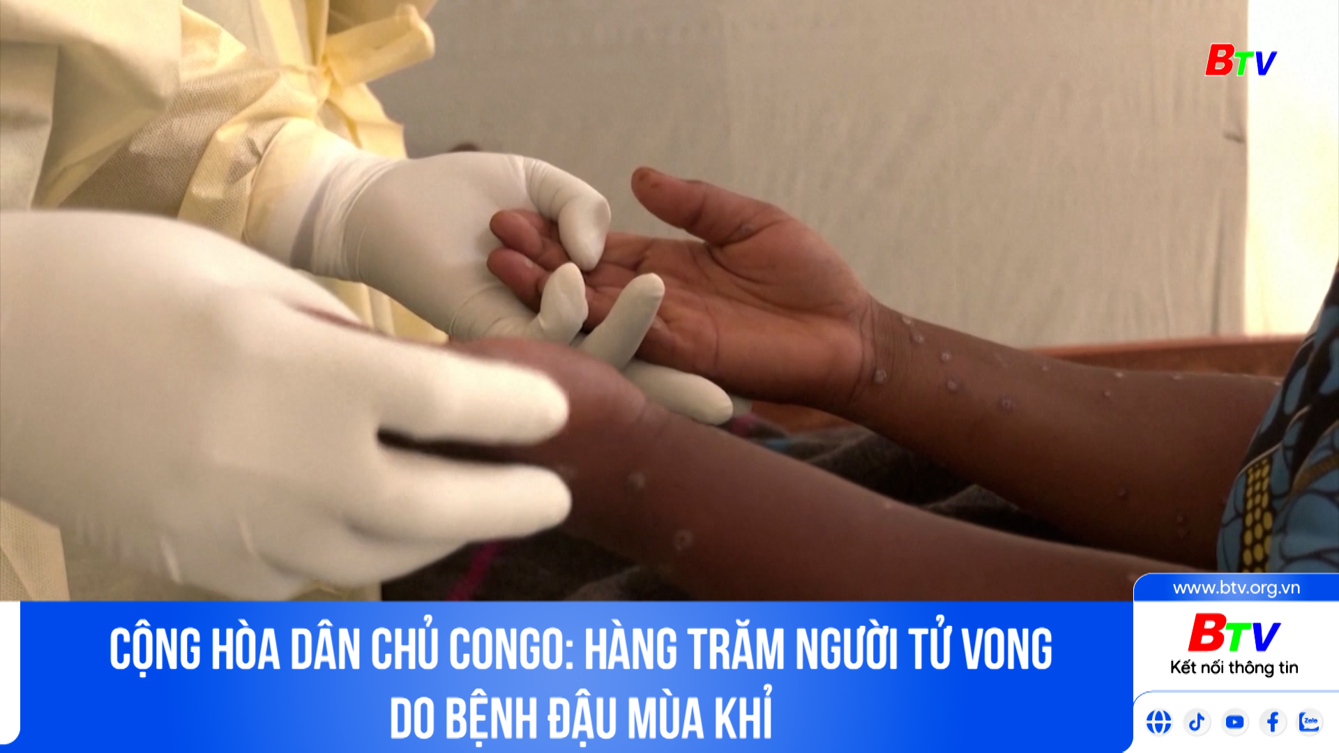 Cộng hòa dân chủ Congo: hàng trăm người tử vong do bệnh đậu mùa khỉ